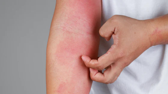 How to Treat Eczema Without Steroids in Children