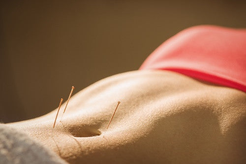 Accupuncture needles in a woman's stomach, an example of natural morning sickness relief