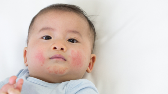 A baby with dry, red cheeks, one of the common symptoms of baby eczema